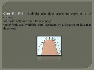 Rule 4:If the second molar is missing not to be replaced that is the opposing second molar is also missing and is not considered in the classification.Rule 5 – The most posterior edentulous area or areas always determines the classification.Rule 6 –Edentulous areas other than those determining the classification are referred to as the modification spaces and are designated by their number.
