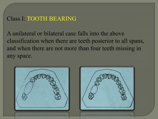 Bailyn’s system:Based on whether the prosthesis is tooth borne, tissue borne or a combination of the two:Bailyn divided all R.P.Ds into-A: Anterior restorations: saddle area 	anterior to the 1st bicuspidsP: Posterior restorations: saddle area 	posterior to the cuspids.