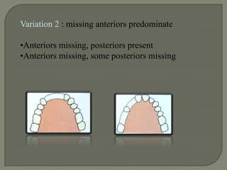 Class A.III : Edentulous space anterior to the 1st bicuspid 