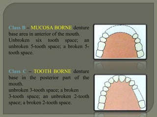 DIVISION 2: when there are teeth posterior in all spans, but when there are more than 4 teeth in any one or more spans.VARIATION 1 : missing posteriors predominatea.noneb.posteriors missing, some anteriors missingVARIATION 2 : missing anteriors predominateanteriors missing, posteriors in place