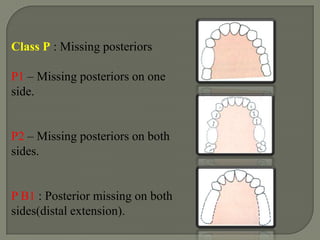 Class D – Class D has mucosa borne denture bases in the posterior part of the mouth. It may be an unbroken 4-tooth space or a 3 tooth; 2 tooth or single tooth space.