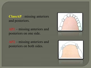 FRIEDMAN’S CLASSIFICATION Introduced ‘ABC’ classification in 1953. According to this classification-A: AnteriorB: Bounded posteriorC: Cantilever
