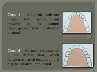 Class I : BOUNDED SADDLE. Abutment teeth qualified to support the denture. Mucosa is not used for support.Class II: FREE ENDa. Tooth and tissue borneb. Tissue borne
