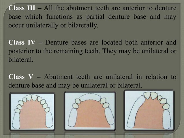 Classification of rpd | PPTX | Dental Health | Diseases and Conditions