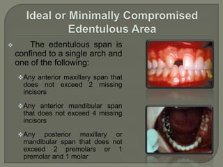 ENTIRELY TISSUE BORNE: Entire denture rests on soft tissue.PARTIALLY TOOTH BORNE AND PARTIALLY TISSUE BORNE: These dentures rest on both teeth and the tissues.