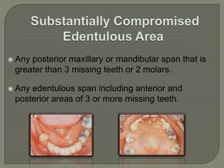 COSTA’S CLASSIFICATIONThis system developed in 1974 was based on describing rather than classifying partially dentulous arches. 