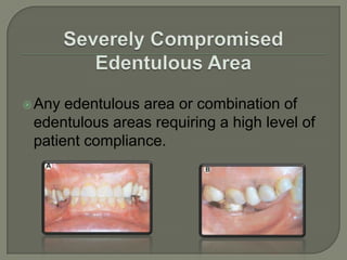 Anterior: Edentulous space located in the anterior part of dental arch.