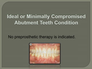 Terminal : Edentulous space not bounded distally by remaining teeth.THANK YOU!!
