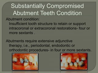 This partially edentulous classification system offers the following potential benefits:Improved intra-operator consistency.Improved professional communication.An objective method for patient screening in dental education.Standardized criteria for outcome assessment and research.Improved diagnostic consistency .Simplified, organized aid in the decision to refer a patient.