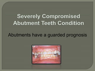 Classification System for the Partially Edentulous PatientDIAGNOSTIC CRITERIA Location and extent of the edentulous area(s)Condition of the abutment teethOcclusal schemeResidual ridge