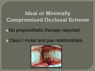 Ideal or Minimally Compromised Edentulous AreaThe edentulous span is confined to a single arch and one of the following: