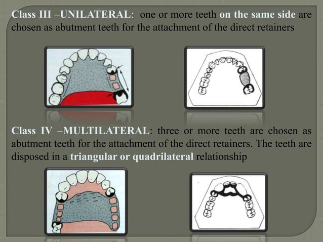 Classification of rpd | PPTX | Dental Health | Diseases and Conditions