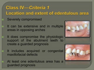 Class I—Criteria 2Abutment conditionAbutment teeth condition is ideal or minimally compromised. No need for preprosthetictherapy.