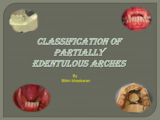 Classification of partially edentulous arches           By  Bibinbhaskaran 
