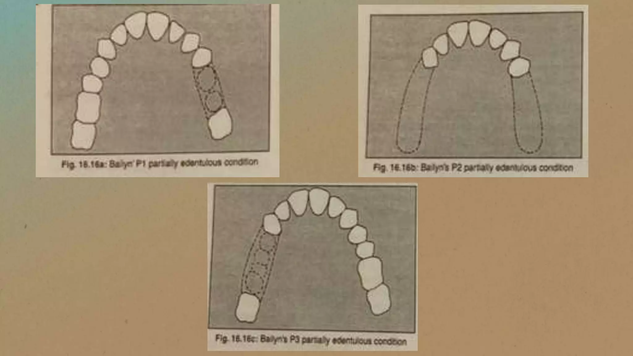 Classification of rpd (lecture) | PPSX