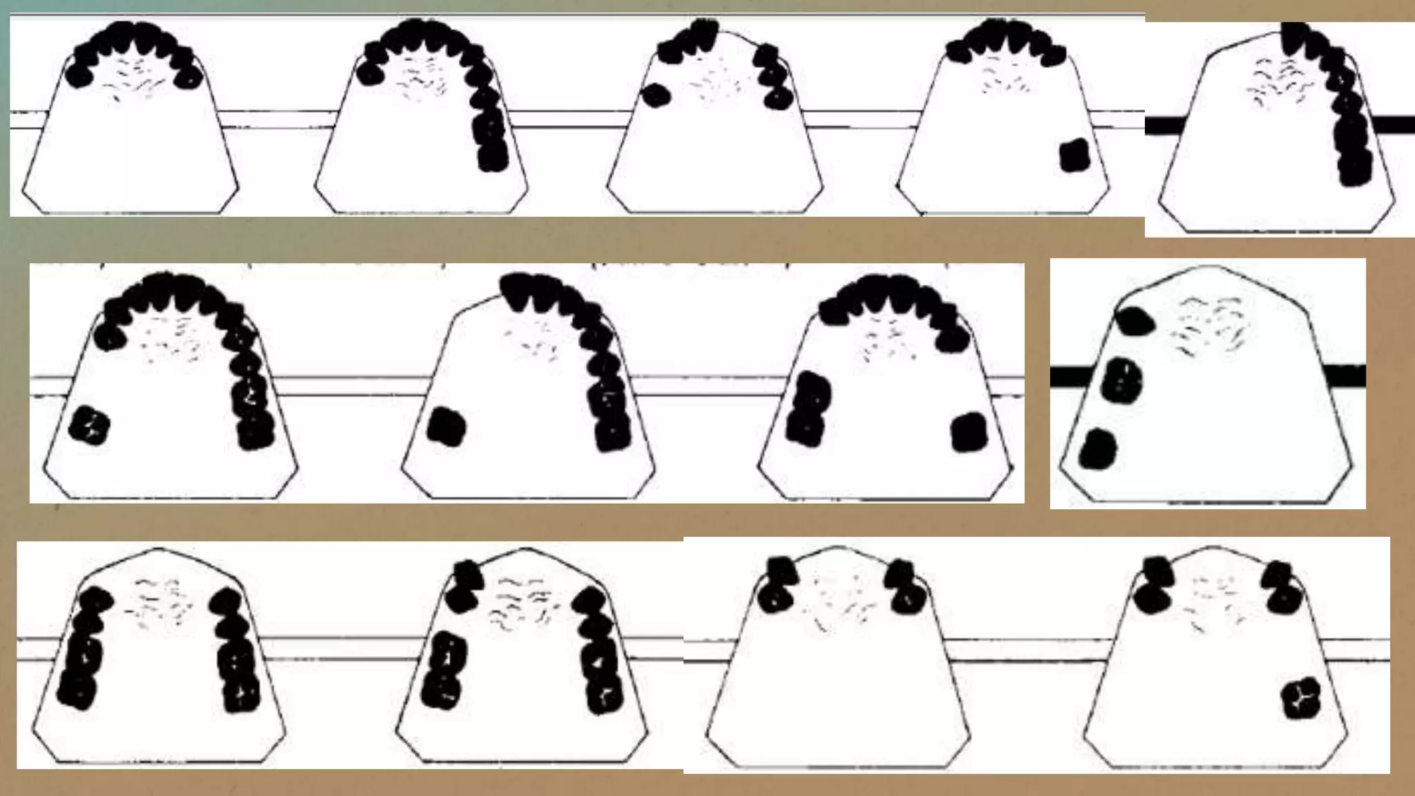 Classification of rpd (lecture) | PPSX