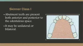 Skinner Class I
▪ Abutment teeth are present
both anterior and posterior to
the edentulous space.
▪ It may be unilateral or
bilateral.
 