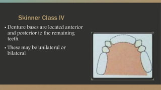 Skinner Class IV
▪ Denture bases are located anterior
and posterior to the remaining
teeth.
▪ These may be unilateral or
bilateral
 