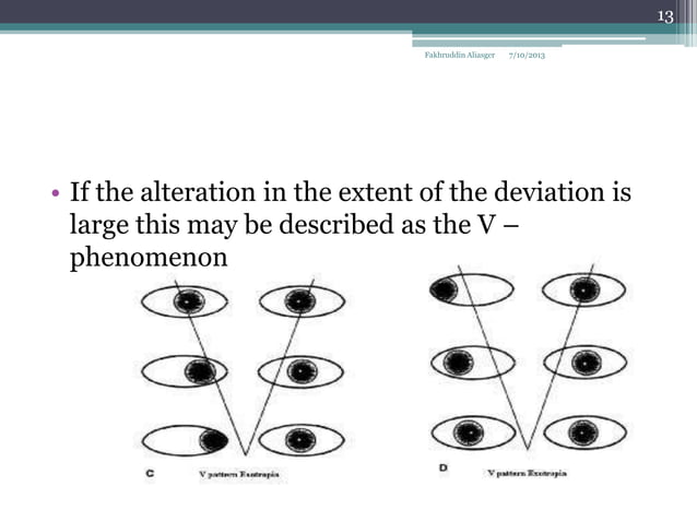 Classification of squint | PPT