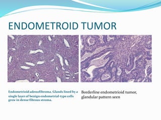 Classification of the tumors of the ovary | PPTX