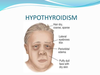 Transient
Thyroiditis
Temporary T4
replacement
 