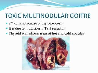Classification of Thyroid Diseases
