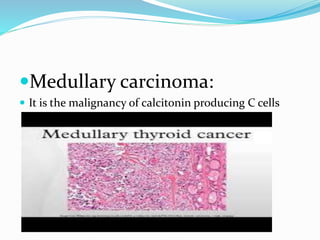 Classification of Thyroid Diseases