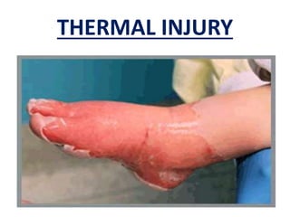 THERMAL INJURY
 