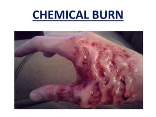 CHEMICAL BURN
 