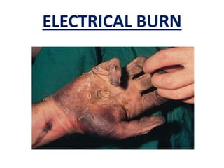 ELECTRICAL BURN
 