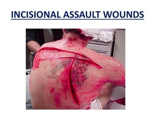 INCISIONAL ASSAULT WOUNDS
 