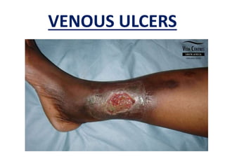 VENOUS ULCERS
 