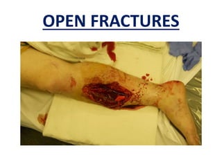 OPEN FRACTURES
 