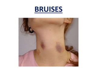 BRUISES
 