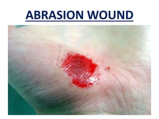 ABRASION WOUND
 