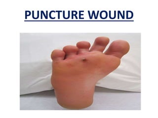 PUNCTURE WOUND
 