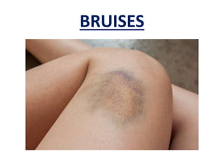BRUISES
 