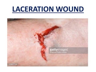 LACERATION WOUND
 