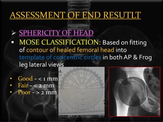 Mose Classification Classification perthes Disease | PDF