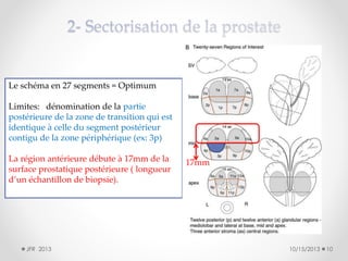 Le schéma en 27 segments = Optimum
Limites: dénomination de la partie
postérieure de la zone de transition qui est
identique à celle du segment postérieur
contigu de la zone périphérique (ex: 3p)
La région antérieure débute à 17mm de la
surface prostatique postérieure ( longueur
d’un échantillon de biopsie).

JFR 2013

17mm

10/15/2013

10

 