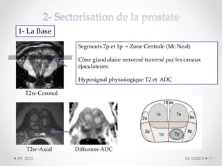 1- La Base
Segments 7p et 1p = Zone Centrale (Mc Neal)
Cône glandulaire renversé traversé par les canaux
éjaculateurs.
Hyposignal physiologique T2 et ADC
T2w-Coronal

T2w-Axial
JFR 2013

Diffusion-ADC
10/15/2013

11

 