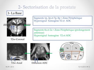 1- La Base
Segments 1p, 2p et 7p, 8p = Zone Périphérique
Hypersignal homogène T2 et ADC

Segments 8a et 2a = Zone Périphérique (prolongement
antérieur)
Hypersignal homogène T2 et ADC
T2w-Coronal

T2w-Axial
JFR 2013

Diffusion-ADC
10/15/2013

12

 
