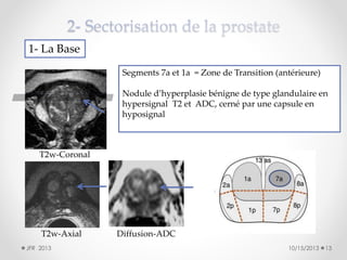 1- La Base
Segments 7a et 1a = Zone de Transition (antérieure)
Nodule d’hyperplasie bénigne de type glandulaire en
hypersignal T2 et ADC, cerné par une capsule en
hyposignal

T2w-Coronal

T2w-Axial
JFR 2013

Diffusion-ADC
10/15/2013

13

 