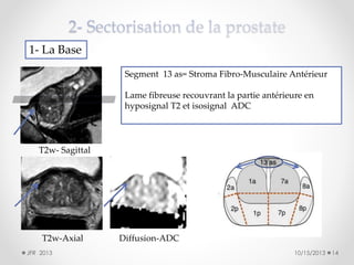1- La Base
Segment 13 as= Stroma Fibro-Musculaire Antérieur
Lame fibreuse recouvrant la partie antérieure en
hyposignal T2 et isosignal ADC

T2w- Sagittal

T2w-Axial
JFR 2013

Diffusion-ADC
10/15/2013

14

 