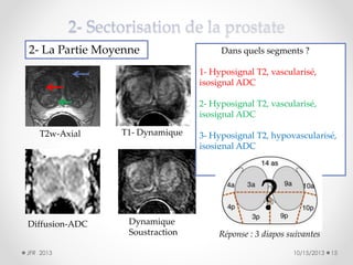 2- La Partie Moyenne

Dans quels segments ?

1- Hyposignal T2, vascularisé,
isosignal ADC
2- Hyposignal T2, vascularisé,
isosignal ADC
T2w-Axial

Diffusion-ADC
JFR 2013

T1- Dynamique

Dynamique
Soustraction

3- Hyposignal T2, hypovascularisé,
isosignal ADC

?
Réponse : 3 diapos suivantes
10/15/2013

15

 