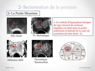 2- La Partie Moyenne

T2w-Axial

T1- Dynamique

Diffusion-ADC

1- Ce nodule d’hyperplasie bénigne
de type stromal de contours
réguliers est situé dans la partie
antérieure et latérale de la zone de
transition du lobe droit: 3a

Dynamique
Soustraction

JFR 2013

10/15/2013

16

 