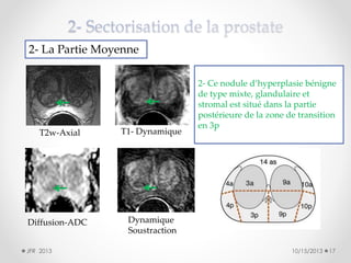 2- La Partie Moyenne

T2w-Axial

T1- Dynamique

Diffusion-ADC

2- Ce nodule d’hyperplasie bénigne
de type mixte, glandulaire et
stromal est situé dans la partie
postérieure de la zone de transition
en 3p

Dynamique
Soustraction

JFR 2013

10/15/2013

17

 