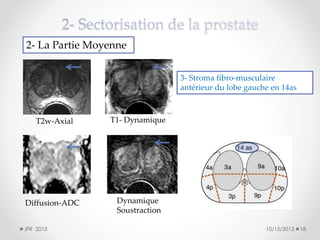 2- La Partie Moyenne
3- Stroma fibro-musculaire
antérieur du lobe gauche en 14as

T2w-Axial

T1- Dynamique

Diffusion-ADC

Dynamique
Soustraction

JFR 2013

10/15/2013

18

 