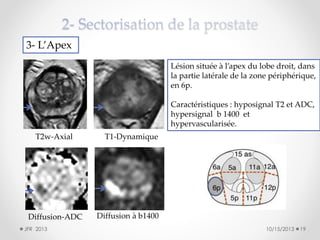 3- L’Apex
Lésion située à l’apex du lobe droit, dans
la partie latérale de la zone périphérique,
en 6p.
Caractéristiques : hyposignal T2 et ADC,
hypersignal b 1400 et
hypervascularisée.
T2w-Axial

Diffusion-ADC
JFR 2013

T1-Dynamique

Diffusion à b1400
10/15/2013

19

 
