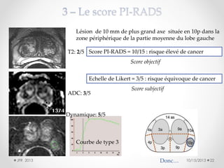 Lésion de 10 mm de plus grand axe située en 10p dans la
zone périphérique de la partie moyenne du lobe gauche
T2: 2/5 Score PI-RADS = 10/15 : risque élevé de cancer

Score objectif
Echelle de Likert = 3/5 : risque équivoque de cancer
ADC: 3/5

Score subjectif

Dynamique: 5/5

Courbe de type 3
JFR 2013

Donc…

10/15/2013

22

 